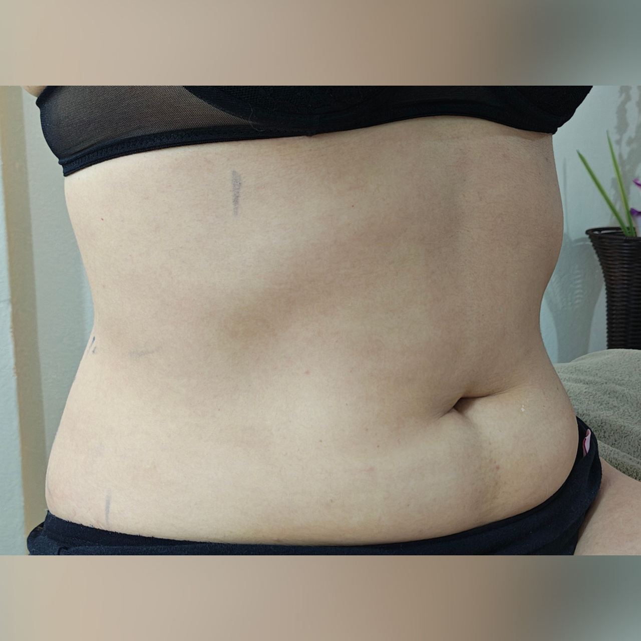 Depois - Body Sculpt - Abdômen