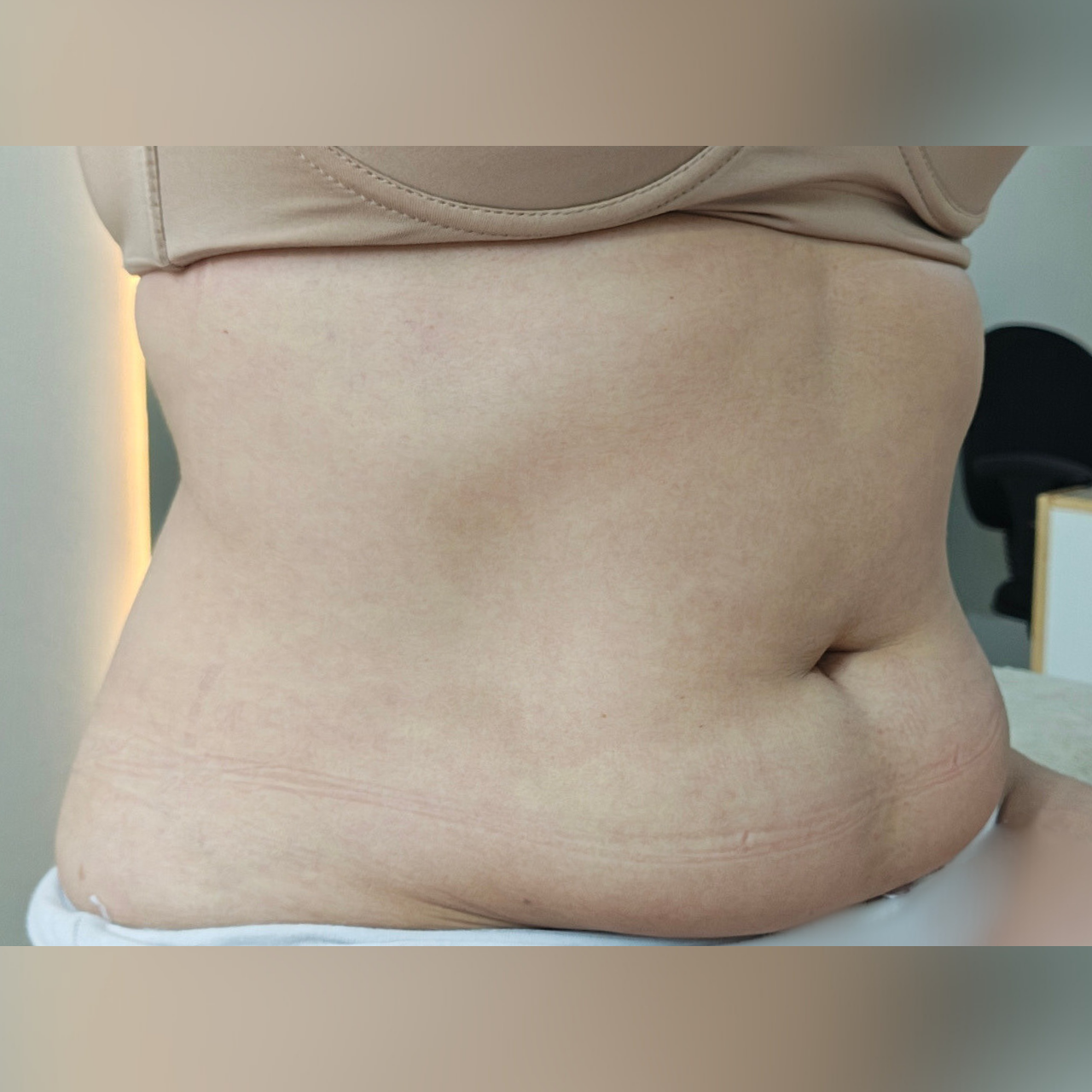 Antes - Body Sculpt - Abdômen
