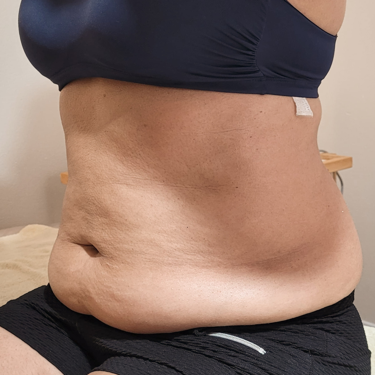 Depois - Body Sculpt - Abdômen