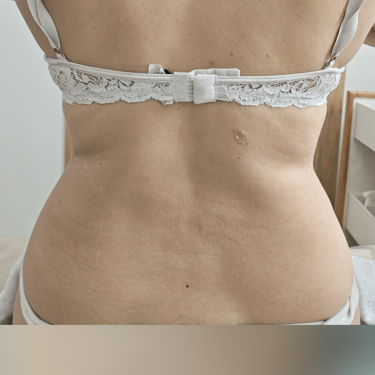 Antes - Body Sculpt - Flancos e Costas