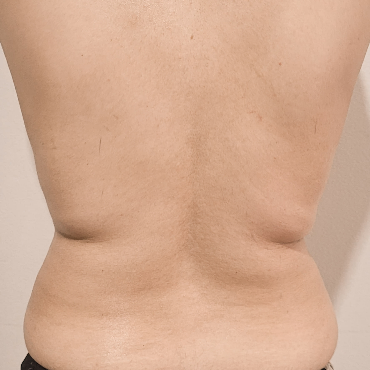 Depois - Body Sculpt - Flancos e Costas