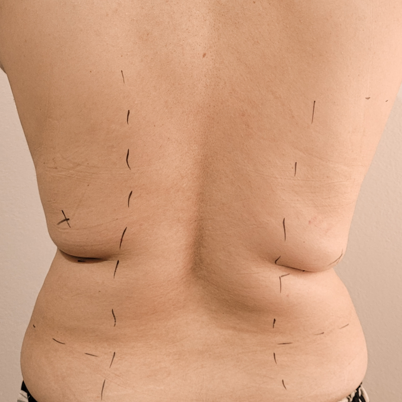 Antes - Body Sculpt - Flancos e Costas